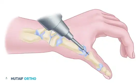 TRAPEZIOMETACARPAL ARTHRODESIS Surgical Diagram