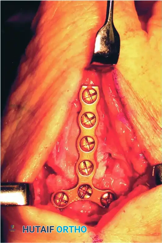 TRAPEZIOMETACARPAL ARTHRODESIS Surgical Diagram