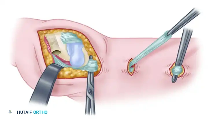 Trapeziometacarpal Ligament Reconstruction and Arthroplasty: A Comprehensive Guide
