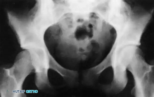 Fig. 33-126 Incongruous reduction of hip. Radiograph of both hips after what was thought to be successful closed reduction of traumatic dislocation of the right hip in adolescent. Reduction is incongruous, however, as shown by break in Shenton line and increase in width of joint space.