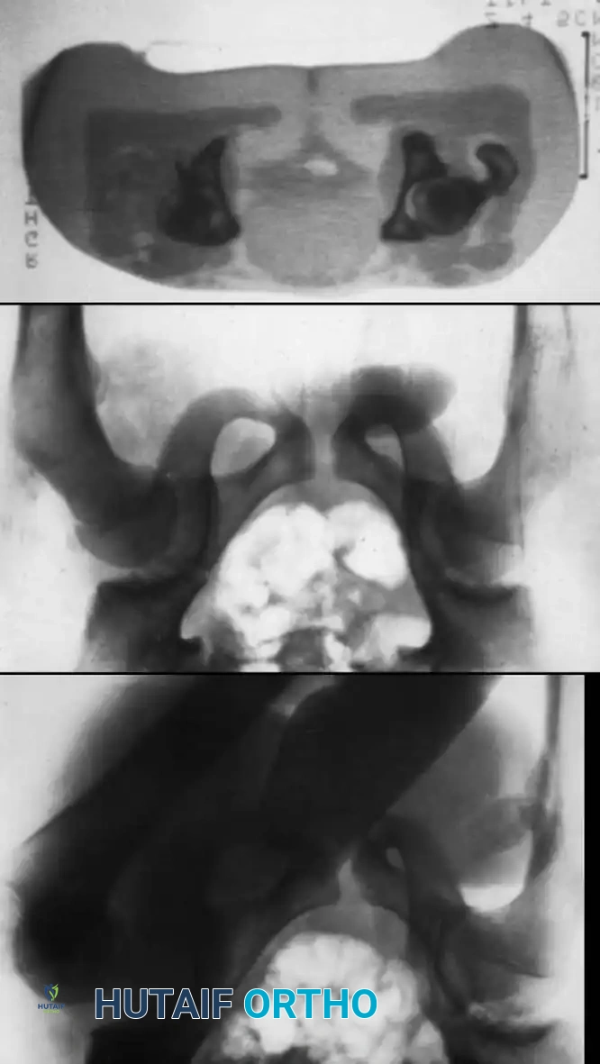 TRAUMATIC HIP DISLOCATIONS IN CHILDREN Surgical Diagram