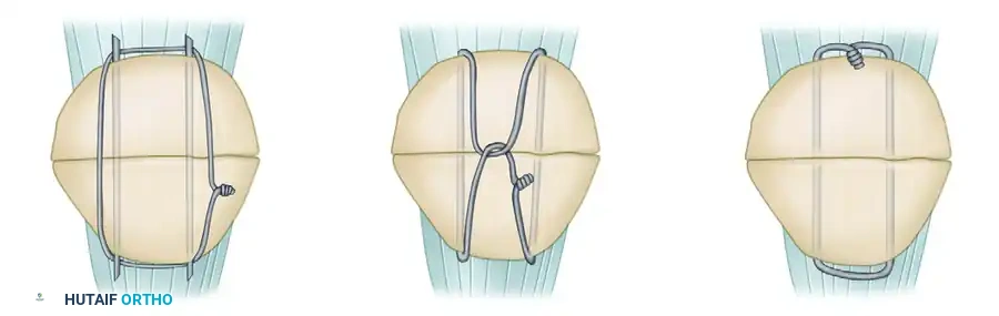 TREATMENT Surgical Diagram