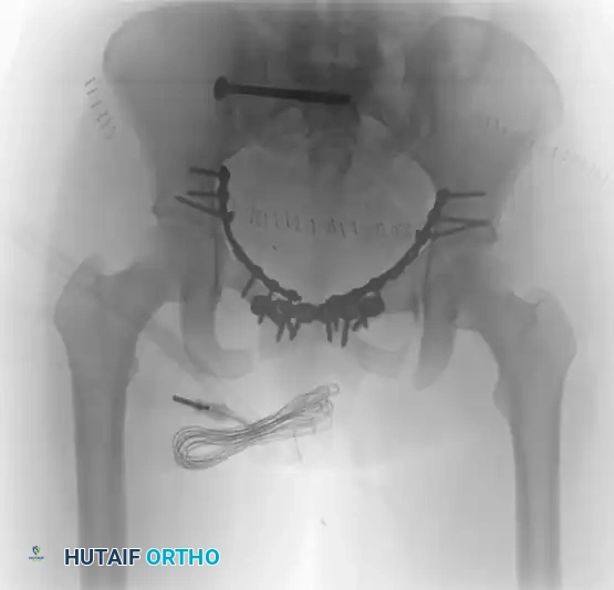 TREATMENT Surgical Diagram