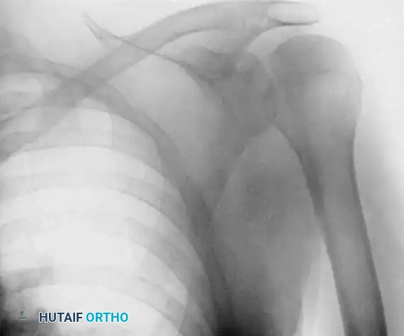 Management of Chronic Unreduced Shoulder Dislocations: A Comprehensive Surgical Guide