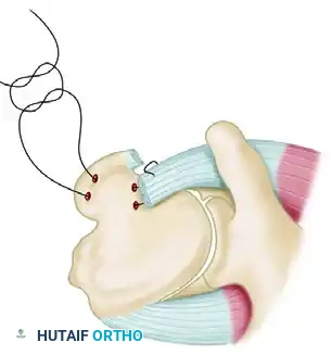 TREATMENT Surgical Diagram