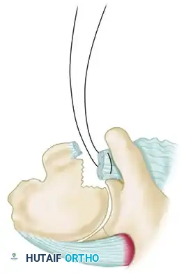 TREATMENT Surgical Diagram