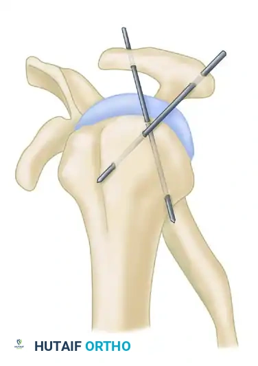 TREATMENT Surgical Diagram