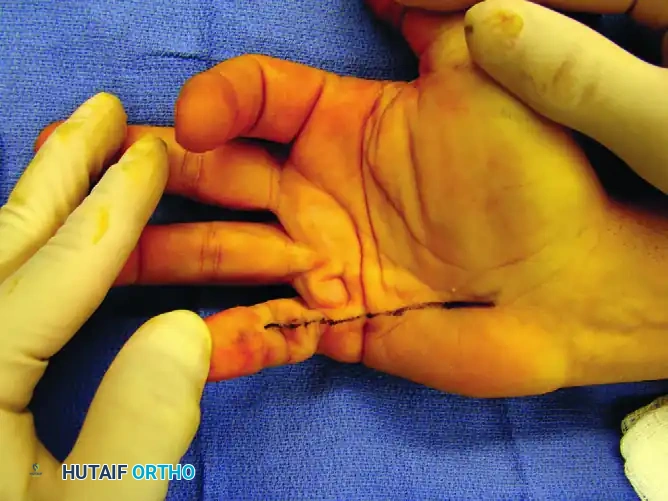 Spiral cord involving little finger