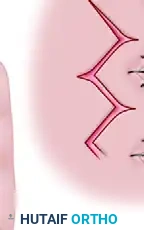 Additional Incision Diagram