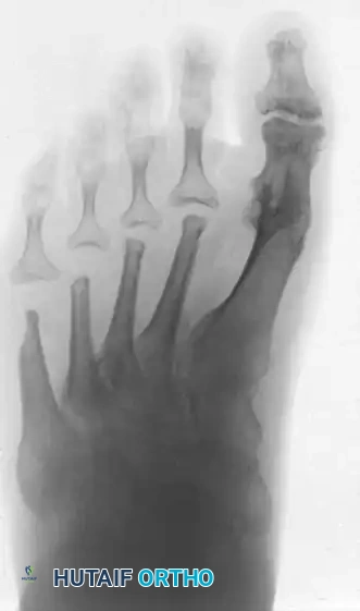 TREATMENT Surgical Diagram