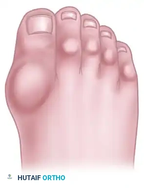 FIGURE 84-3 Rheumatoid foot. Note multiple deformities of rheumatoid arthritis of forefoot with hallux valgus, subluxed and dislocated metatarsophalangeal joints, claw toes, hammer toes, and bursal formation.