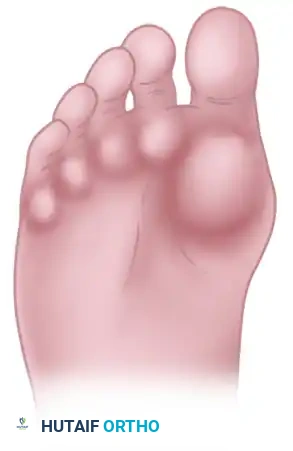 FIGURE 84-4 B, Inadequate bone resection with loss of joint space.