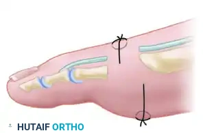 FIGURE 84-5 Forefoot arthroplasty, with resection of metatarsal heads 1 through 5.