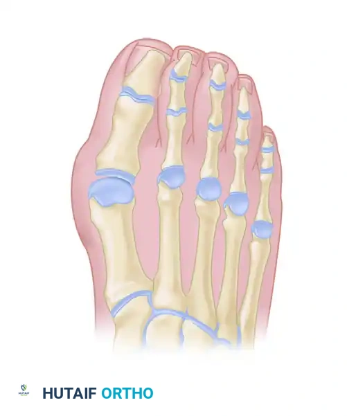 FIGURE 84-6 First metatarsophalangeal joint arthrodesis fixed with plate and one oblique screw.