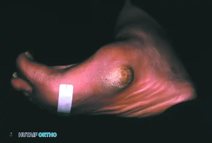 صورة تظهر قصر وانحراف العظام في القدم المصابة