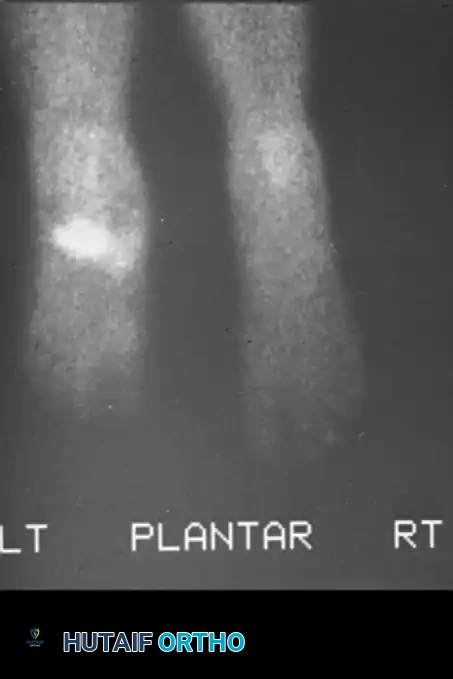 أشعة سينية أمامية وجانبية تظهر تدمير المفاصل الرصغية المشطية