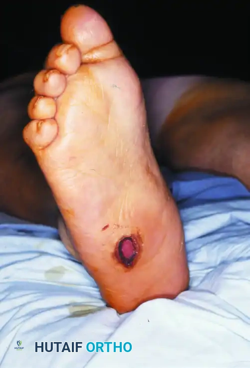 تخطيط الشق الجراحي لإزالة البروز العظمي الأخمصي