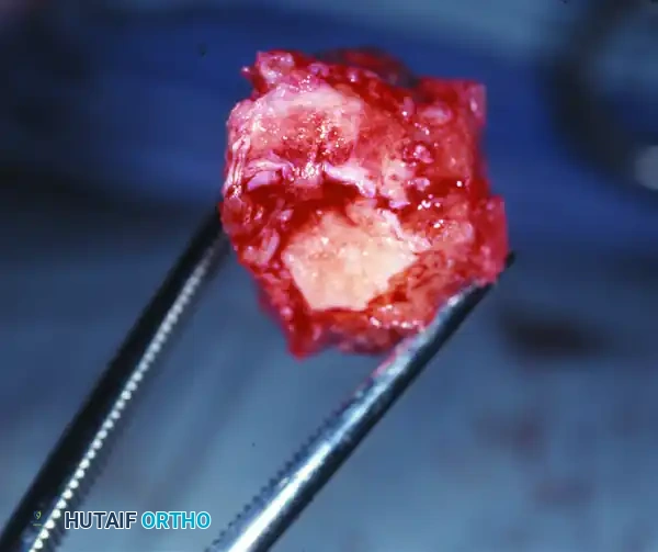 كشف الكتلة العظمية البارزة جراحياً