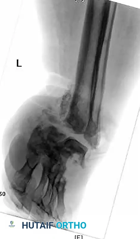 حالة متقدمة من اعتلال مفصل شاركو مع عدوى شديدة وعدم استقرار
