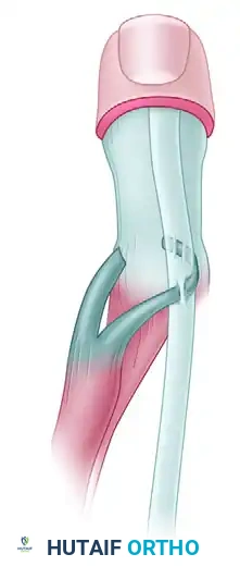 TRICEPS TRANSFER TO RESTORE ELBOW FLEXION Surgical Diagram