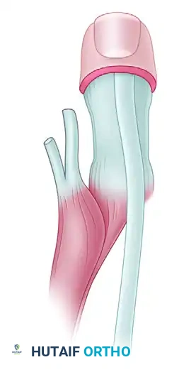 Comprehensive Surgical Management of Congenital Upper Extremity Anomalies: Triceps Transfer and Central Hand Deficiencies