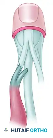 TRICEPS TRANSFER TO RESTORE ELBOW FLEXION Surgical Diagram