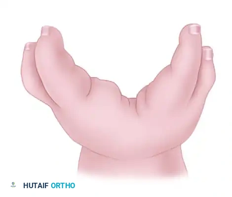 Upton and Taghinia technique for type II cleft hand C