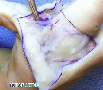 Upton and Taghinia technique for type II cleft hand D