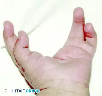 Upton and Taghinia technique for type II cleft hand B