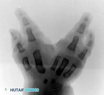 Upton and Taghinia technique for type II cleft hand A