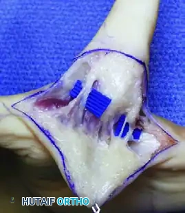 Upton and Taghinia technique for type II cleft hand E