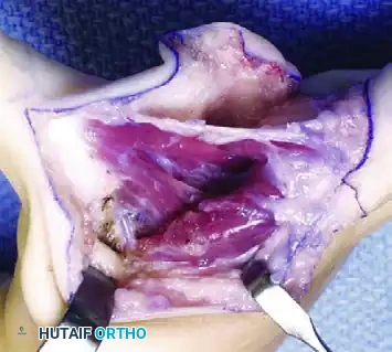 Manske and Halikis Type 5