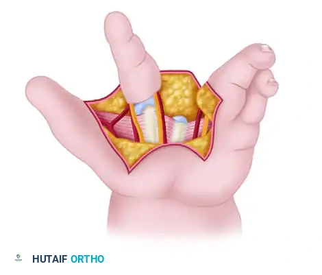 Manske and Halikis Type 1