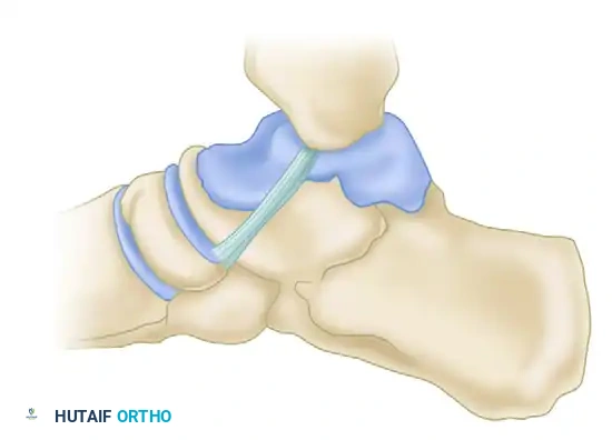 FIGURE 54-10 When deltoid ligament has been avulsed from its distal insertion, it may become reflected proximally and allow posterior tibial tendon to become interposed as shown. Sponta­ neous healing of ligament is impaired.