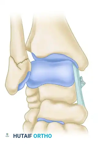 FIGURE 54-10 When deltoid ligament has been avulsed from its distal insertion, it may become reflected proximally and allow posterior tibial tendon to become interposed as shown. Sponta­ neous healing of ligament is impaired.