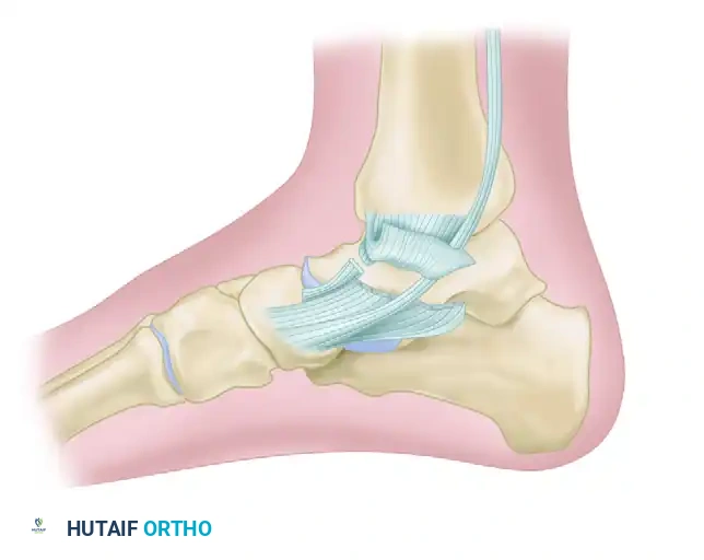 TRIMALLEOLAR FRACTURE Surgical Diagram