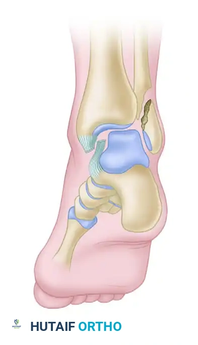 FIGURE 54-9 Trapping of posterior tibial tendon between medial malleolus and talus. Note widening of ankle mortise and avulsion fracture of medial malleolus.
