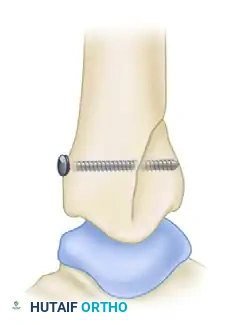 TRIMALLEOLAR FRACTURE Surgical Diagram