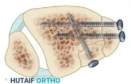 TRIMALLEOLAR FRACTURE Surgical Diagram