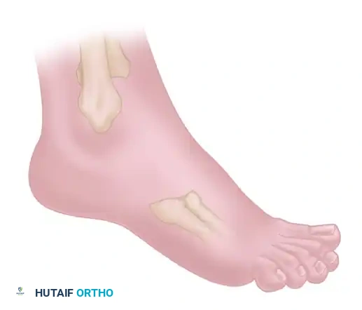 دليل المريض الشامل لعملية إيثاق المفاصل الثلاثي في القدم