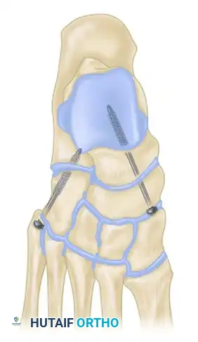 إعادة محاذاة عظام القدم في الوضع التشريحي الصحيح