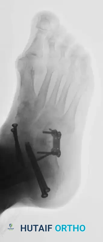 تثبيت المفصل العقبي النردي ومفصل تحت الكاحل