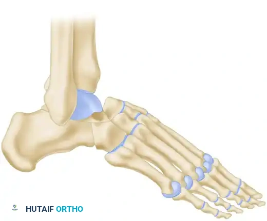 Lambrinudi Arthrodesis - Talar Wedging