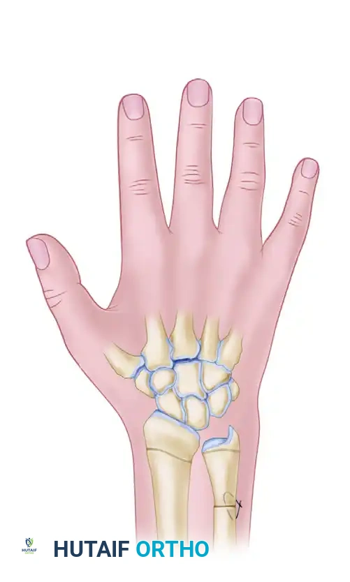 التثبيت الأكثر استقرارا باستخدام تقنية القطع المتدرج والمسمار