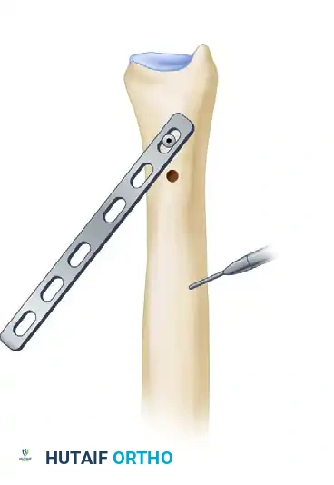 Plate Placement and Marking