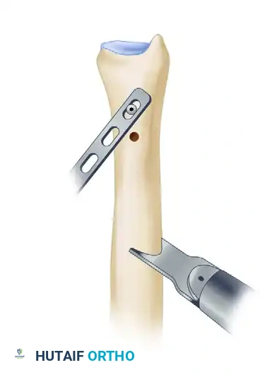 Dynamic Compression Plating