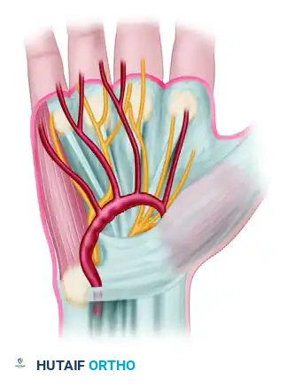 Two types of traumatic aneurysms of ulnar artery in hand. A, Saccular “false” aneurysm arising from ulnar artery.