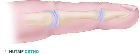 Congenital Hand Undergrowth & Hypoplastic Thumb: Comprehensive Surgical Management