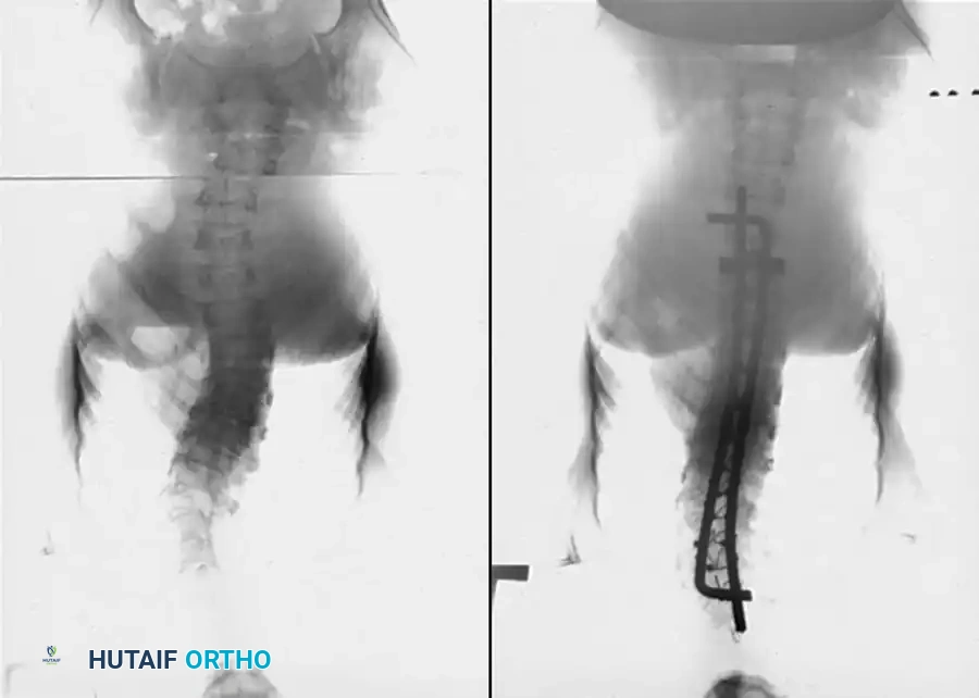 Unusual Causes of Kyphosis: Comprehensive Surgical Management