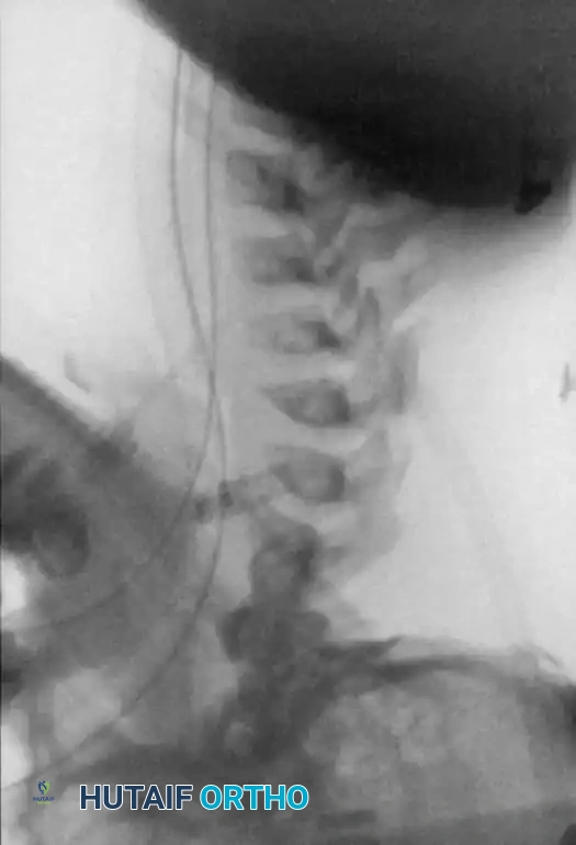 UNUSUAL CAUSES OF KYPHOSIS Surgical Diagram
